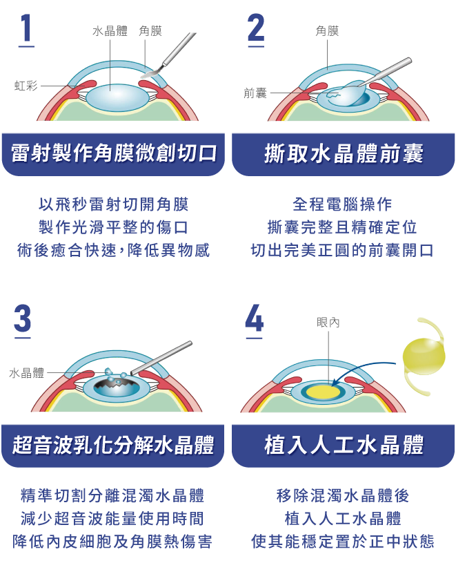 飛秒雷射白內障手術方式